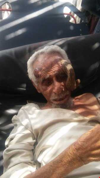 بریدن شاخ پیرمرد یمنی که  ۱۴۰ ساله سن داشت موجب مرگش شد